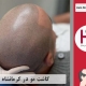 کاشت موی طبیعی در شهر کرمانشاه