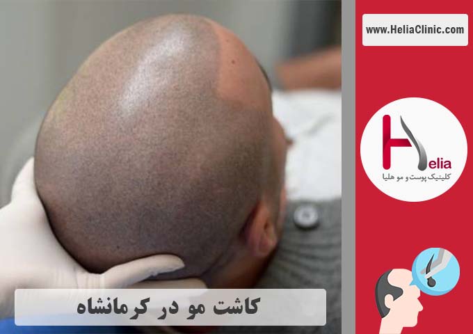 کاشت موی طبیعی در شهر کرمانشاه