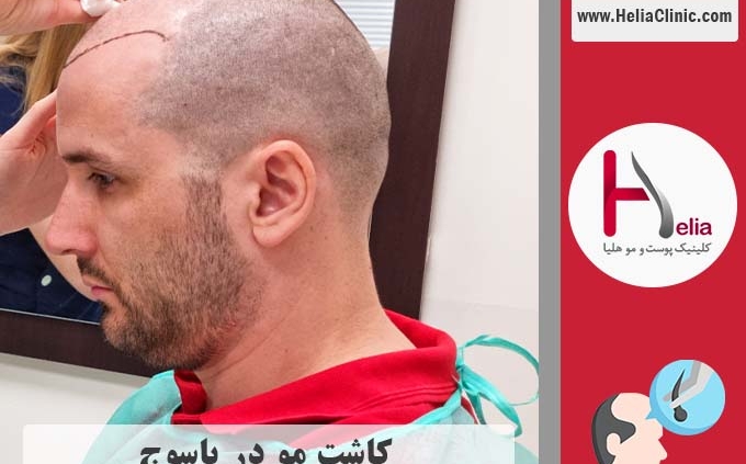کاشت موی طبیعی در شهر یاسوج