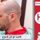 کاشت موی طبیعی در شهر یاسوج