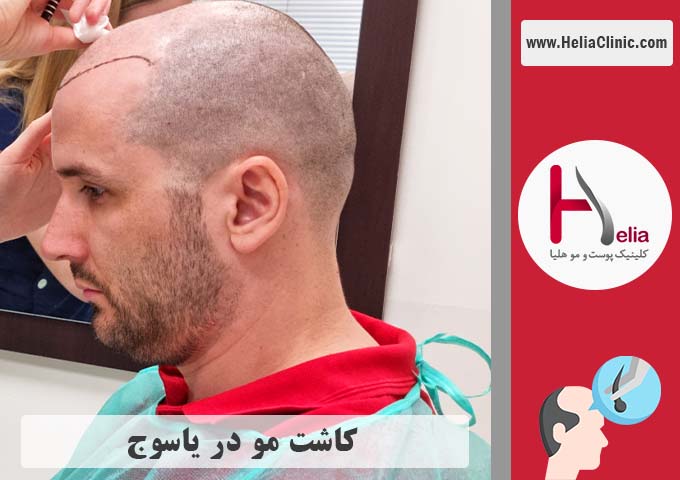 کاشت موی طبیعی در شهر یاسوج