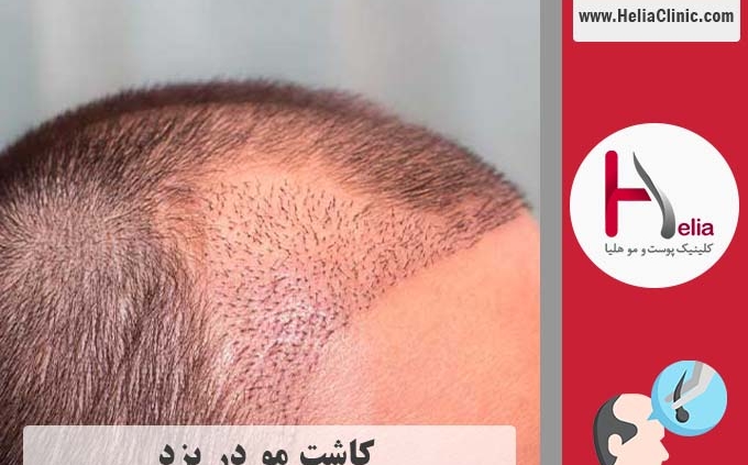 کاشت موی طبیعی در استان یزد