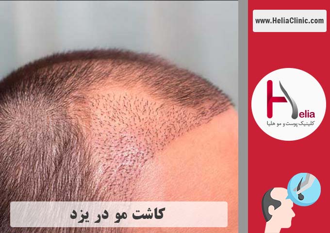 کاشت موی طبیعی در استان یزد
