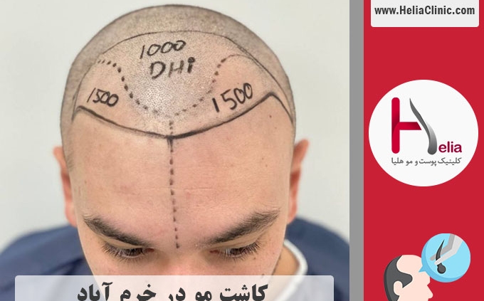 کاشت مو در شهر خرم آباد واقع در استان لرستان