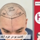 کاشت مو در شهر خرم آباد واقع در استان لرستان