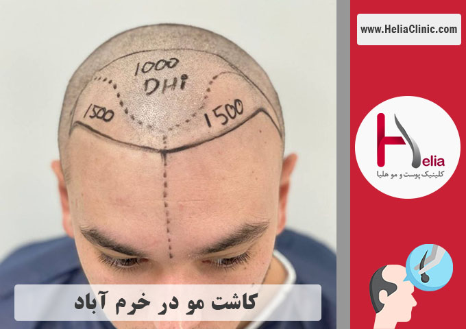 کاشت مو در شهر خرم آباد واقع در استان لرستان