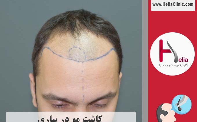 کاشت مو در ساری واقع در استان مازندران