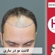 کاشت مو در ساری واقع در استان مازندران