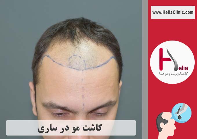 کاشت مو در ساری واقع در استان مازندران