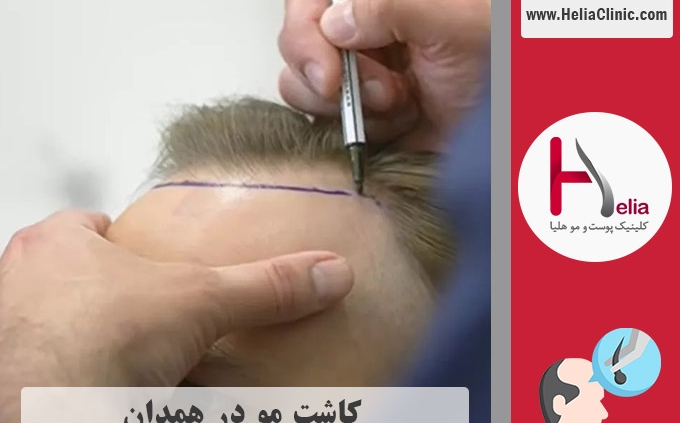 کاشت موی طبیعی در همدان