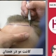 کاشت موی طبیعی در همدان