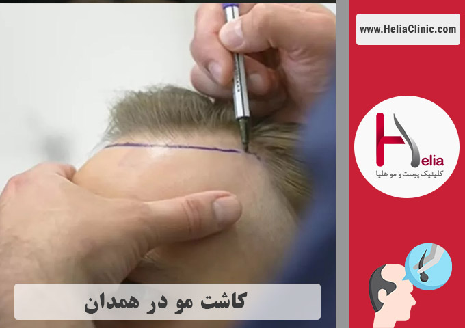 کاشت موی طبیعی در همدان
