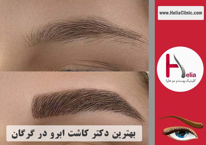 بهترین پزشک متخصص و مرکز کاشت ابرو در گرگان
