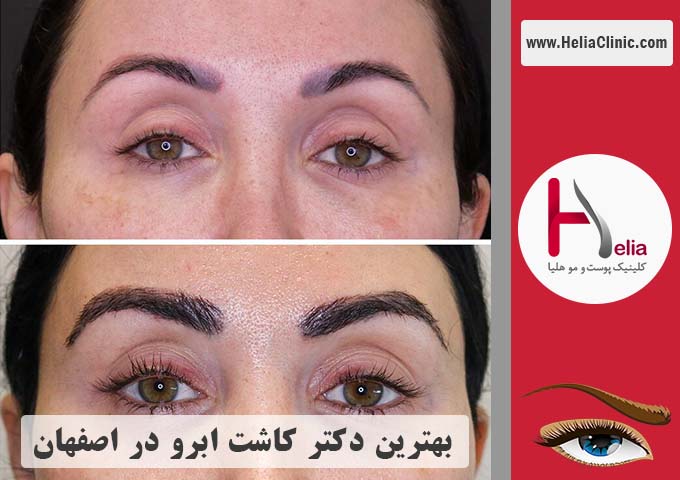 بهترین پزشک و مرکز کاشت ابروی معتبر در اصفهان