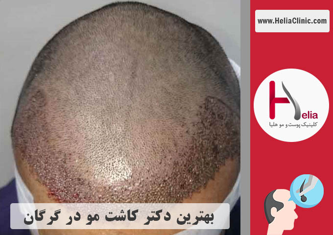 بهترین دکتر متخصص و مرکز کاشت مو در گرگان