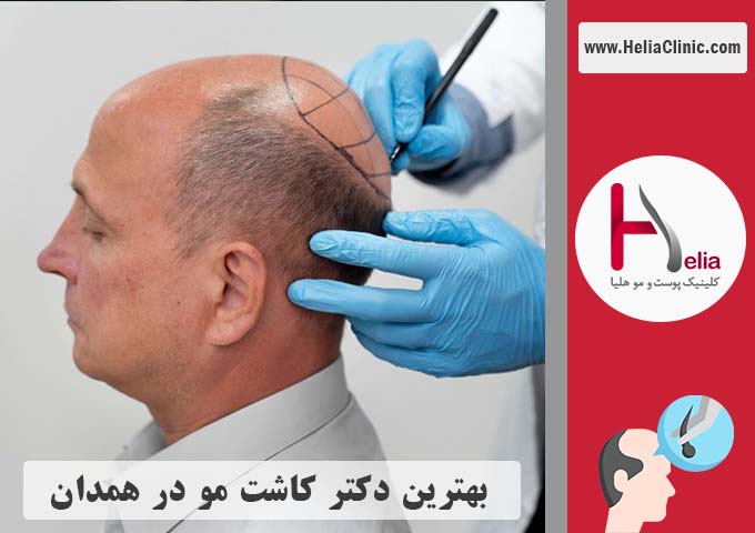بهترین دکتر و کلینیک کاشت موی طبیعی در همدان