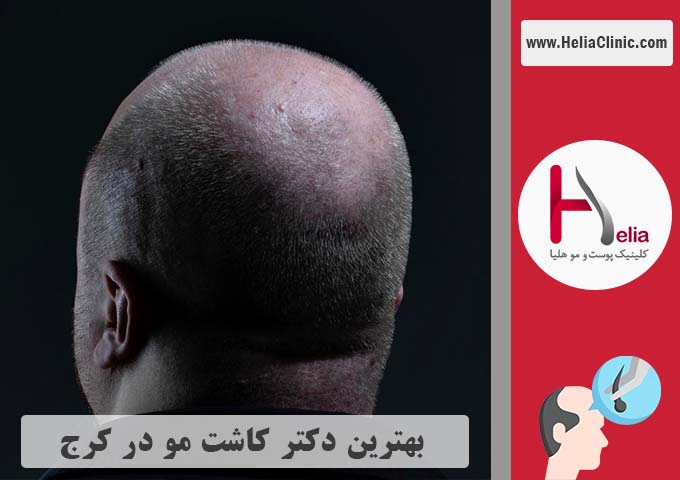 بهترین دکتر متخصص و کلینیک کاشت مو در کرج و استان البرز