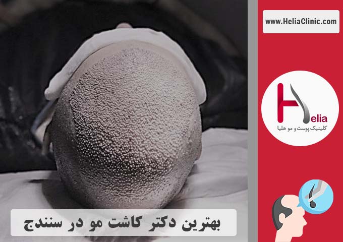 بهترین دکتر و کلینیک کاشت مو در شهر سنندج