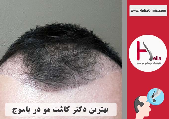 بهترین پزشک و مرکز کاشت مو در یاسوج