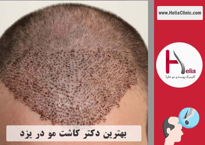 بهترین دکتر و کلینیک مجرب کاشت مو در یزد