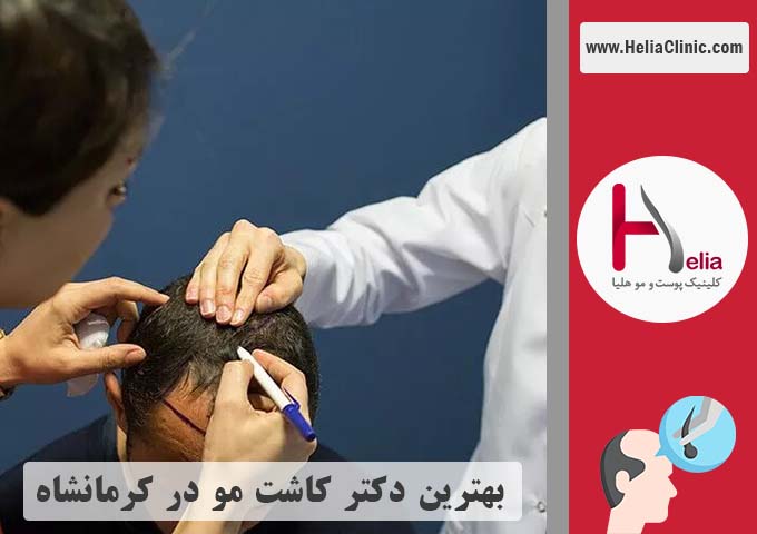 بهترین دکتر کاشت مو در کرمانشاه