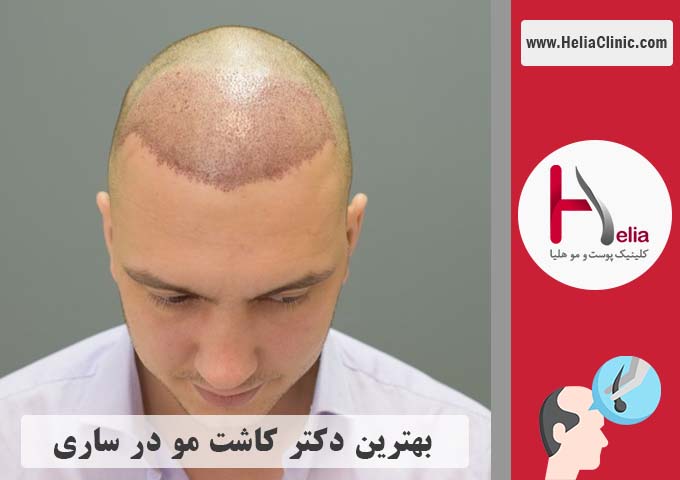 بهترین دکتر و کلینیک کاشت موی در شهر ساری - مازندران
