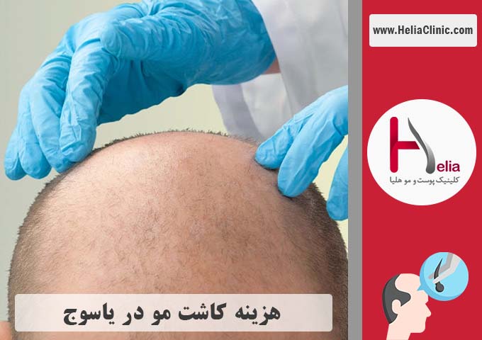 قیمت کاشت موی طبیعی در یاسوج