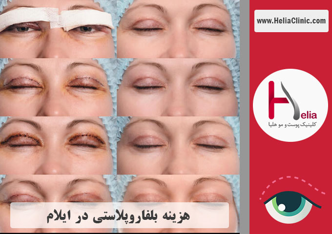 قیمت جراحی زیبایی پلک در ایلام