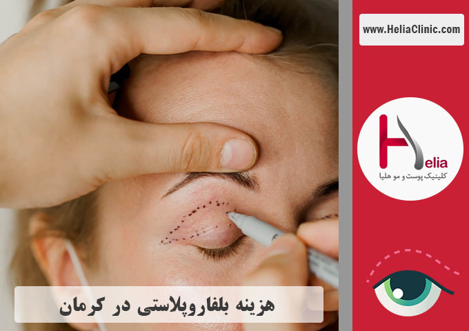 قیمت عمل بلفاروپلاستی در کرمان