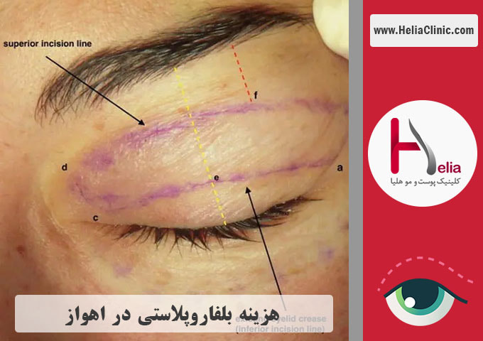 قیمت جراحی پلک در اهواز