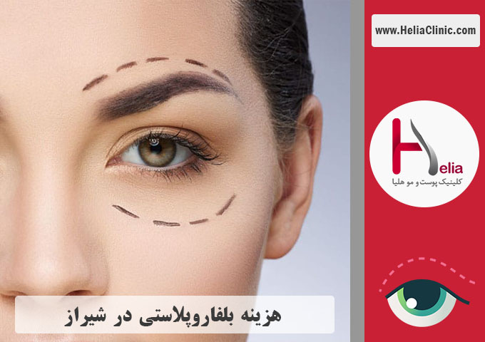 قیمت عمل زیبایی پلک در شیراز