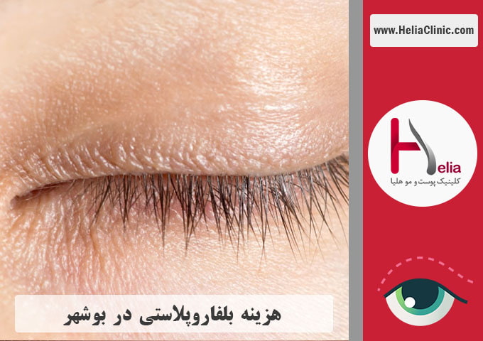 قیمت جراحی پلک در بوشهر