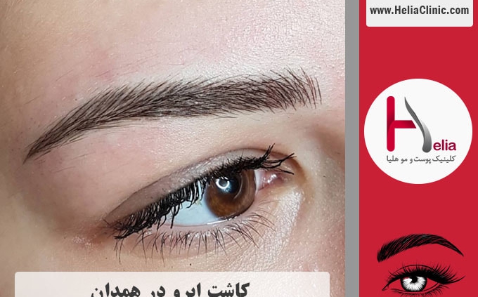کاشت ابرو در همدان