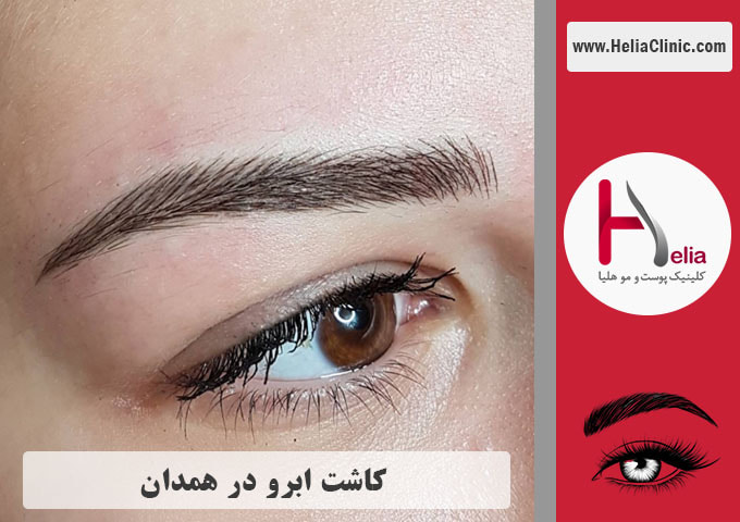 کاشت ابرو در همدان