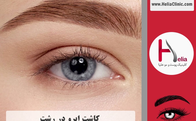 کاشت ابرو در شهر رشت | استان گیلان