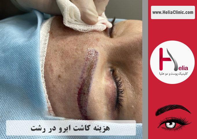 قیمت کاشت ابروی طبیعی در رشت