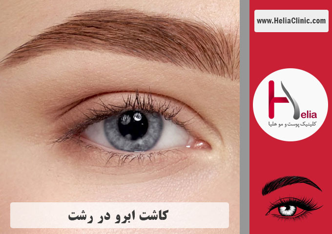 کاشت ابرو در شهر رشت | استان گیلان