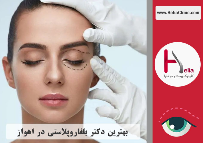 بهترین پزشک عمل پلک در اهواز