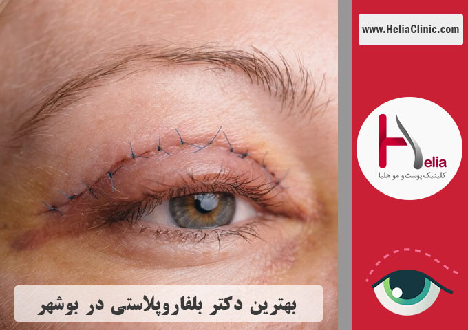 بهترین جراح متخصص جراحی پلک در بوشهر