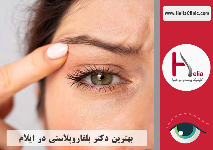 بهترین جراح بلفاروپلاستی در ایلام