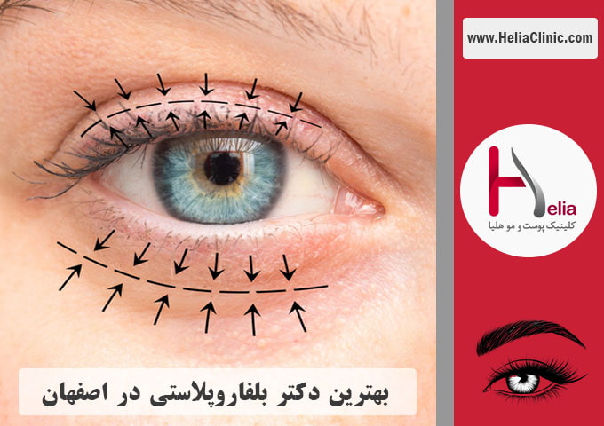 بهترین جراح پلک در شهر اصفهان