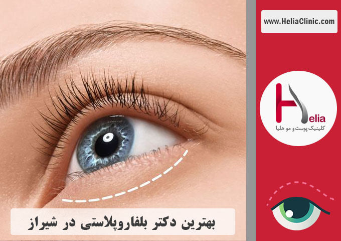 بهترین جراح پلک در شیراز