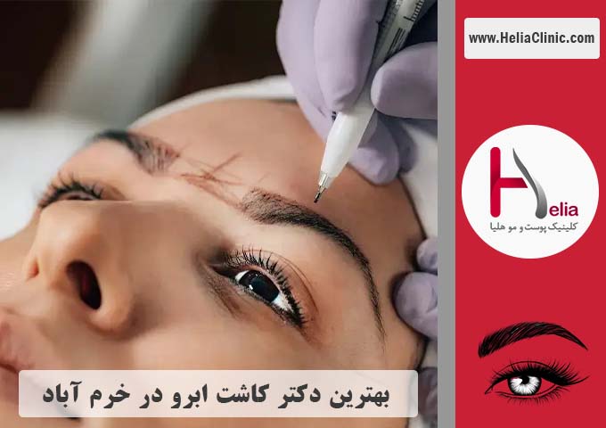 بهترین دکتر و مرکز کاشت ابرو در خرم آباد - لرستان