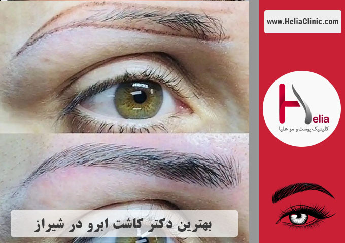 بهترین دکتر و کلینیک کاشت ابروی طبیعی در شیراز