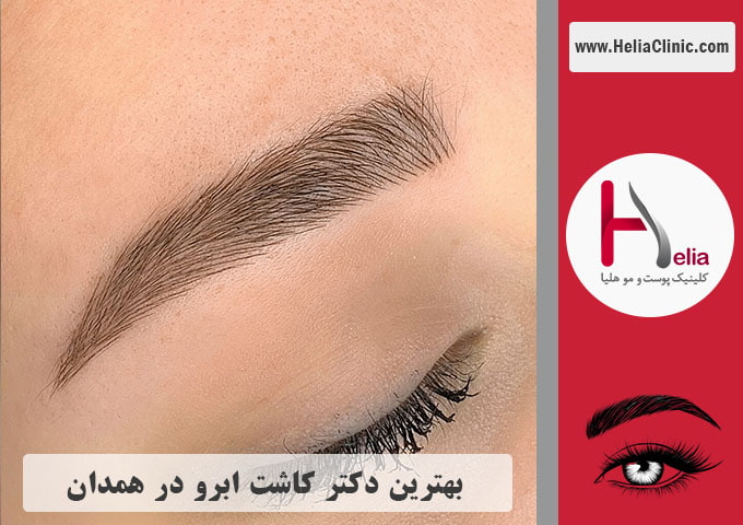 بهترین دکتر و مرکز کاشت ابرو در همدان