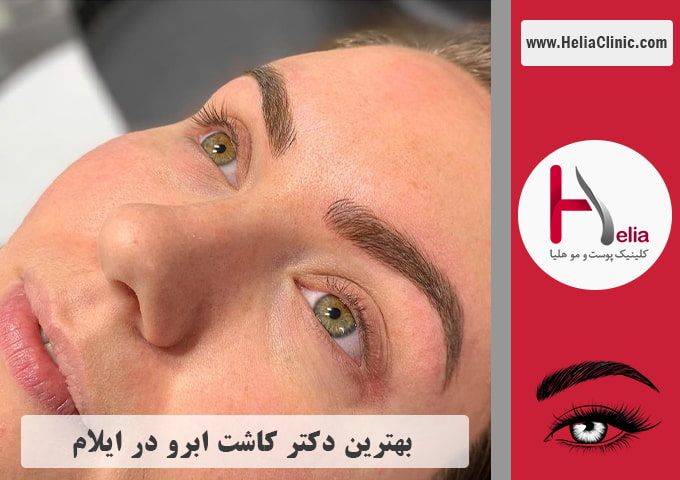 بهترین پزشک و مرکز کاشت ابرو در ایلام
