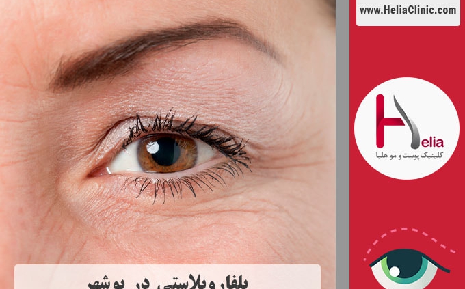 عمل بلفاروپلاستی در بوشهر