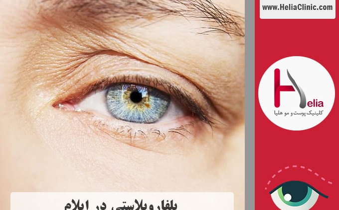 عمل بلفاروپلاستی در ایلام
