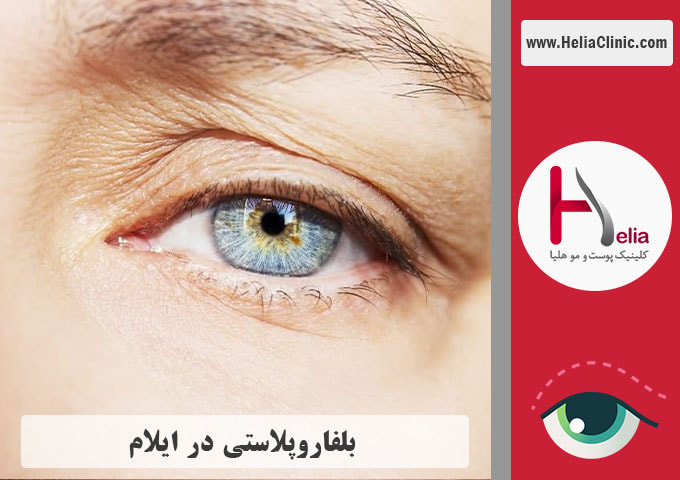 عمل بلفاروپلاستی در ایلام