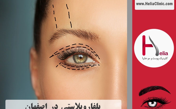 عمل جراجی پلک در اصفهان